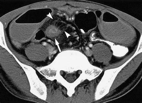 Cross Sectional Imaging In Crohn Disease Radiographics