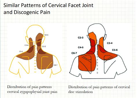 Cervical Spine Pain And Headaches
