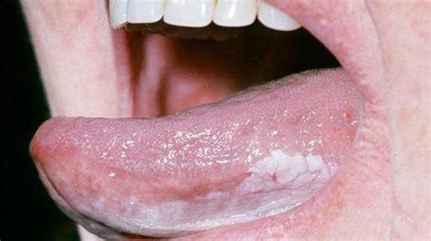 Some of the early symptoms of throat cancer include a hoarse voice, constant sore throat, and the persistent feeling of a lump in the throat. Stage 1 Throat Cancer Pictures - Celine Dion Songs Age