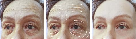 Face Elderly Woman Wrinkles Cosmetology Contrast Correction Before