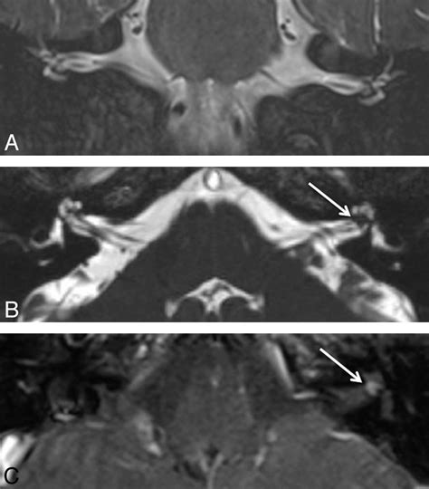 Diagnostic Accuracy Of Screening Mr Imaging Using Unenhanced Axial Ciss