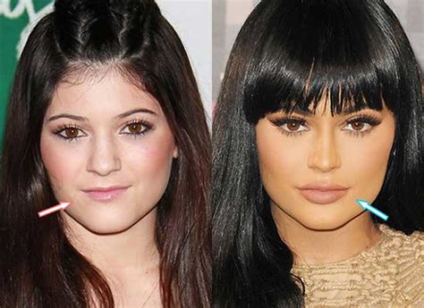 before and after surgery pics of kylie jenner