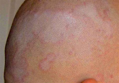 Shiitake Dermatitis Causes Symptoms And Treatment Wsmbmp