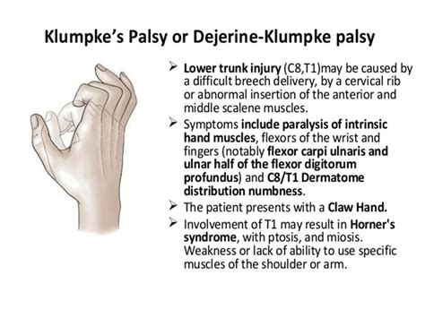 Klumpkes Palsy Brachial Plexus Injury C To T Paralysis Of Hand And Wrist Muscles Claw Hand