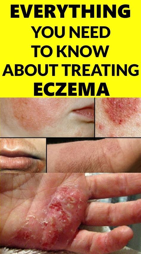 Everything You Need To Know About Treating Eczema How To Treat Eczema