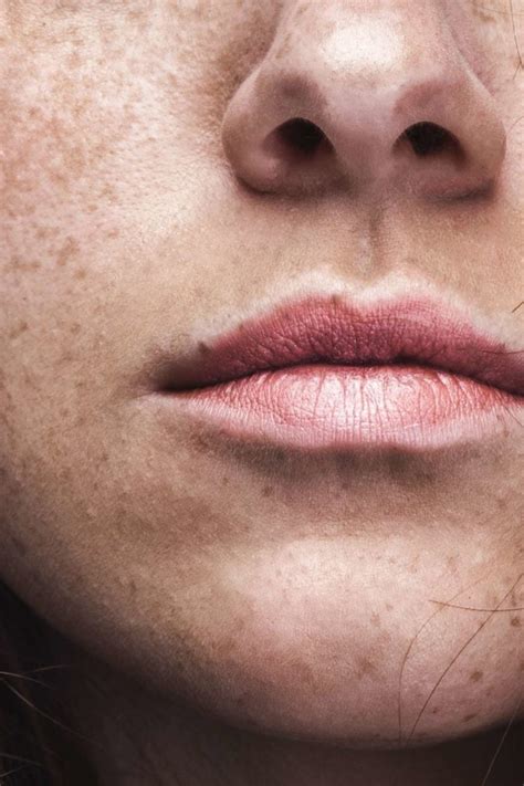 Freckles How To Tell If A Freckle Could Be An Indication Of A More Serious Health Issue