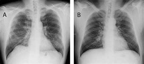 A Chest X Ray Showing Right Hilar Enlargement A Subsequent Ct Scan