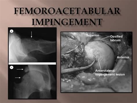 Femoroacetabular20 Impingement 1