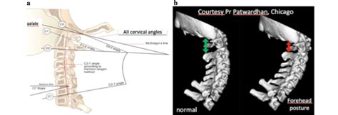 A Cervical Parameters High O C2 And Low C2 C7 Cervical Angles B