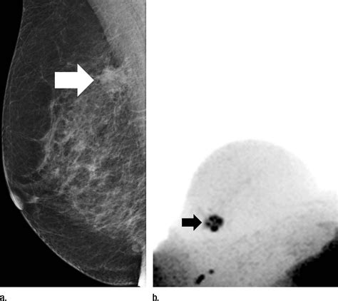 Mammogram 1 Of 3 Image Eurekalert Science News Releases