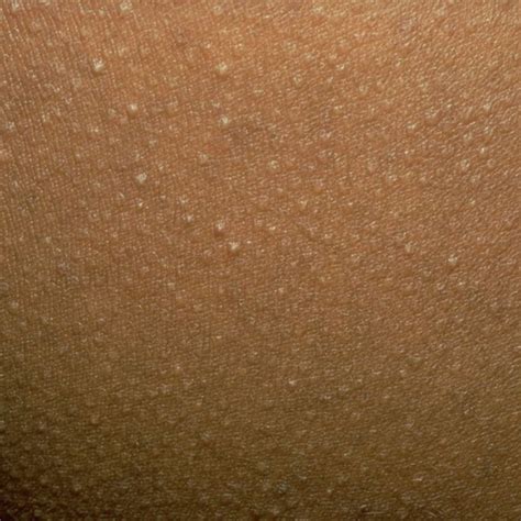 If You See One Of These 18 Bumps On Your Skin Do Not Pop