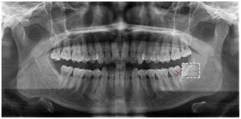 Osteomyelitis Jaw After Wisdom Teeth Extraction