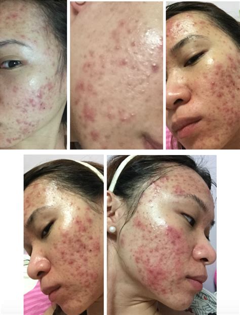 Review The Long Lasting Cure For Cystic Acne At The Clifford Clinic