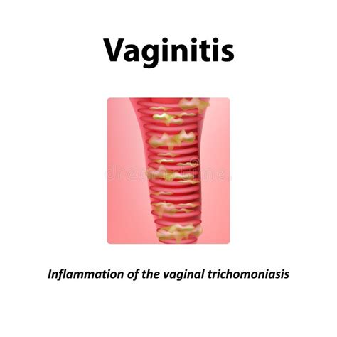 Inflammation Du Vagin VAGINITIS Trichomoniasis De Vaginitis Infographie