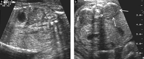 Enlarged Adrenal Glands As A Prenatal Marker Of Congenital Adrenal