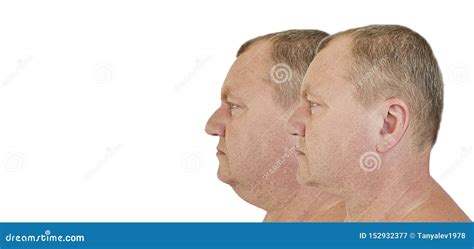 Male Double Chin Before And After Treatment Sagging Stock Image Image