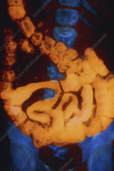 Coloured X Ray Of A Colon With Crohns Disease Stock Image M130