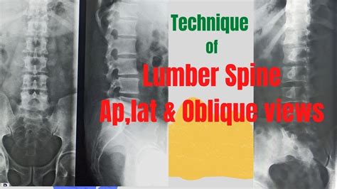 Technique Of L Spine Ap Lat And Oblique Views Ep 63 X Ray Lumber