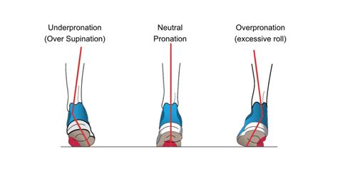 Overpronation Vs Underpronation Causes Injuries And Treatments