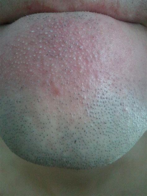 Red Bumps On Scrotum