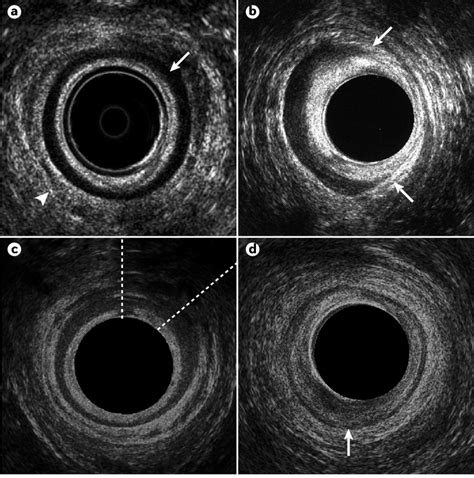 Representative Endoanal Ultrasonography Images A The Mid Anal