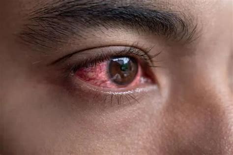 10 Serious Causes Of Red Eyes And How To Treat Them Credihealth
