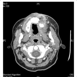 CT Of Neck Demonstrating Bilateral Diffuse Lymphadenopathy With The