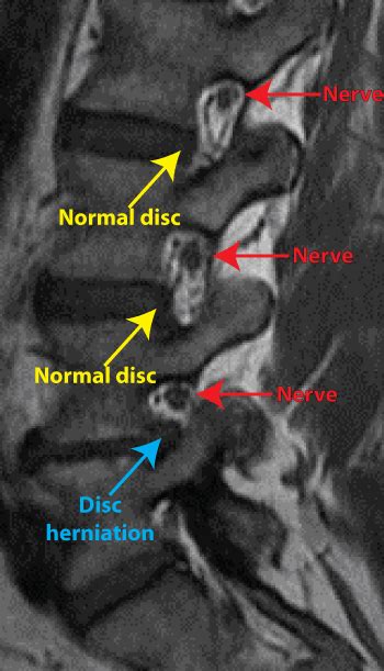 How To Understand Your Complex Spine Mri In 8 Easy Steps