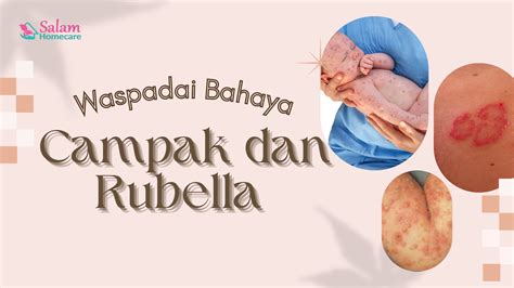 Jarang Disosialisasikan Waspadai Bahaya Campak Dan Rubella Salam