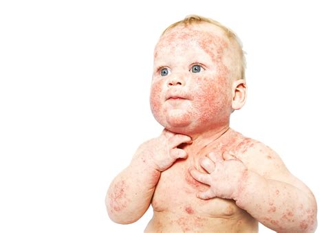 Qué es la dermatitis atópica en el bebé y el niño Tratamiento