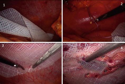 Laparoscopic Ventral Hernia Repair Abdominal Key