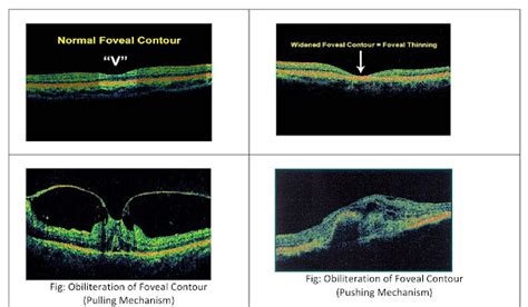 Interpretation Of Optical Coherence Tomography Oct A Basic Approach