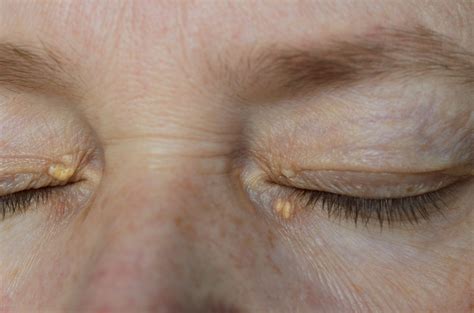 Xanthelasma Removal In Singapore Getting Rid Of Cholesterol Deposits