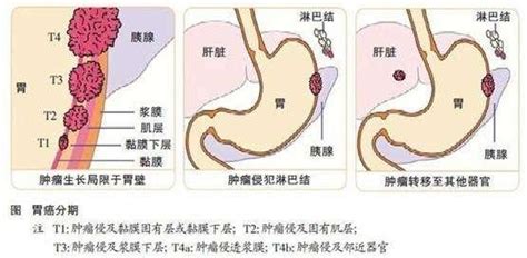 Achlorhydria 胃酸缺乏症 digestive system 消化系統 dumping syndrome 胃切除後産生的腹瀉、嘔吐等現象 endoscopy 內視鏡 esophagus 食道 gastrectomy 胃切除術 gastric 胃 gastric atrophy 胃萎縮 gastroenterologist 胃腸專家. 胃癌晚期還能活多久？胃癌晚期症狀是什麼樣的？ - 每日頭條