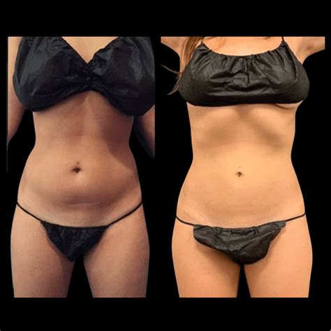 Abs Waist Liposuction Before After Neinstein Plastic Surgery