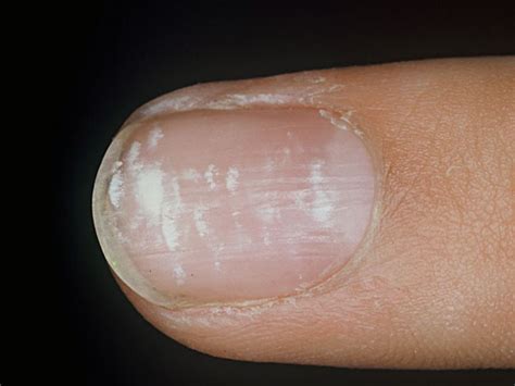 Total leukonychia, partial leukonychia, terry nails, punctate leukonychia, longitudinal leukonychia, mees' lines, transverse leukonychia, muehrcke lines, apparent. Unghia