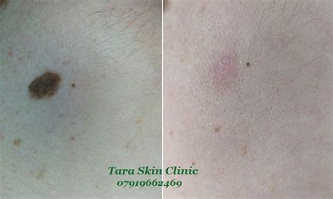 Tara Skin Clinic Skin Blemish Removal