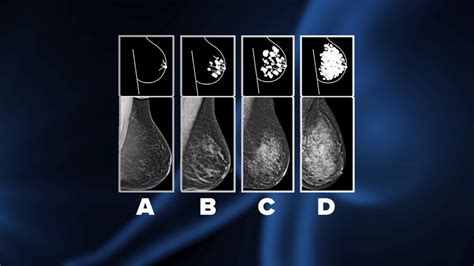 doctors in montana are not required to tell women they have dense breast tissue a known risk