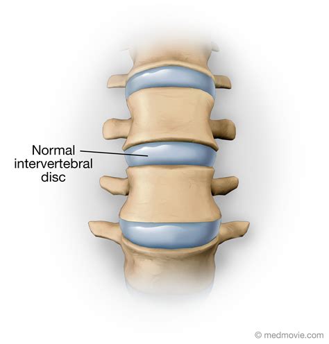 Normal Intervertebral Disc