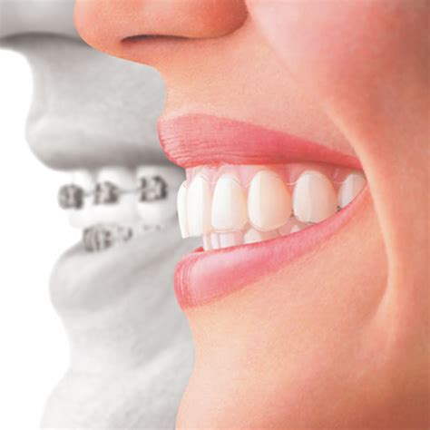 Invisalign Invisible Braces Cheltenham From Arnica Dental Care