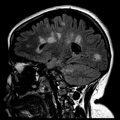This article is an updated version of the 2013 article and focusses on the role of mri in the diagnosis of multiple sclerosis. Controversial 'liberation therapy' fails to treat multiple ...