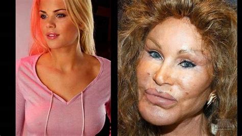 10 Celebrity Before And After Plastic Surgery Disasters Celebrity