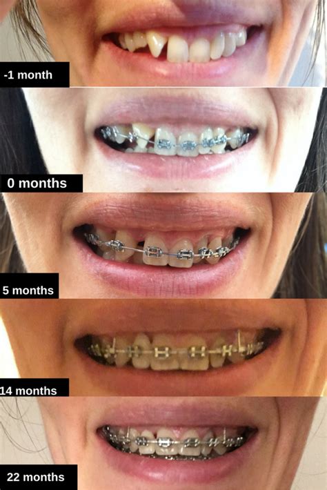 Braces At 30 14th Tightening 22 Months Before And After Photos Orthodontics Braces