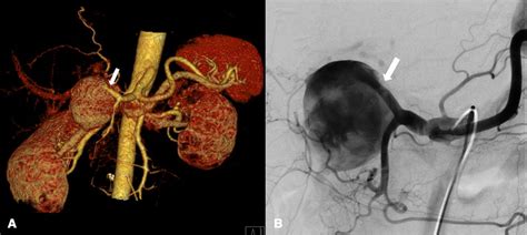 Hepatic Artery Aneurysm Rare Cause Of Epigastralgia And Melena