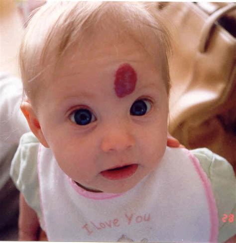 Redefining The Face Of Beauty Child Skin Disorder Hemangioma Of Skin