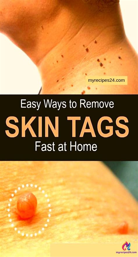 How To Remove Skin Tags According To Dermatologists With Images