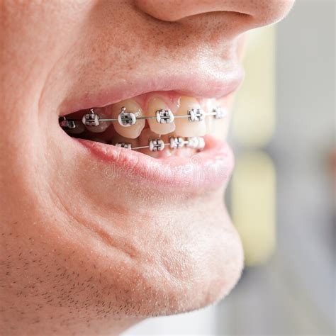 Macro Photography Of Human S Mouth With Metal Braces On Teeth Stock