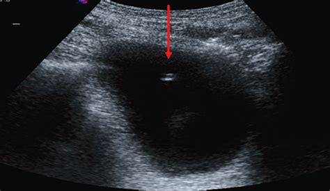 Suprapubic Catheter Insertion Using An Ultrasound‐guided Technique And