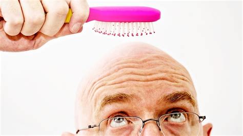 Researchers Find A Cure For Baldness Or So They Say Netmag Pakistan