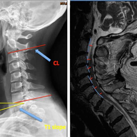 A C2c7 Sagittal Vertical Axis B C2c7 Lordosis C T1 Slope And D
